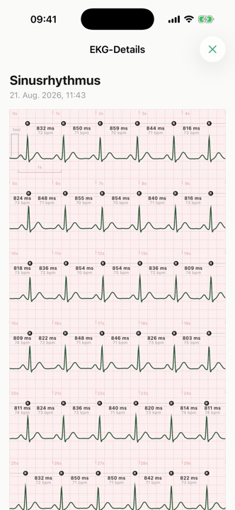 Ansicht einer EKG-Aufzeichnung