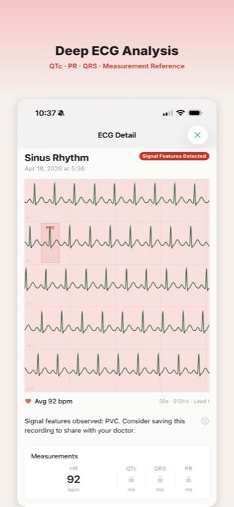 ECG detail view with intervals